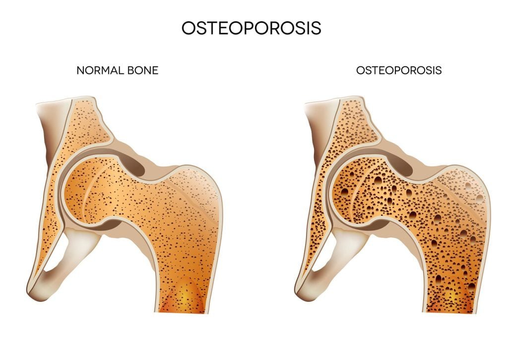 Osteoporose | Dr. Fernando Ferro | Cirurgia do Quadril em Goiânia