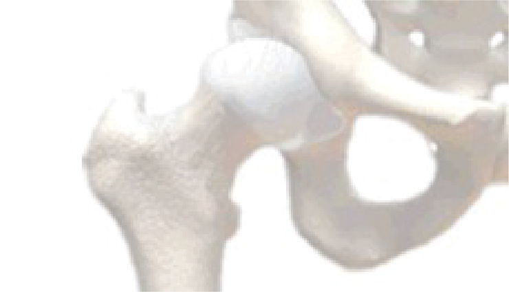 Artroplastia Total do Quadril (ATQ) em Goiânia | Dr. Fernando Ferro | Cirurgia do Quadril em Goiânia