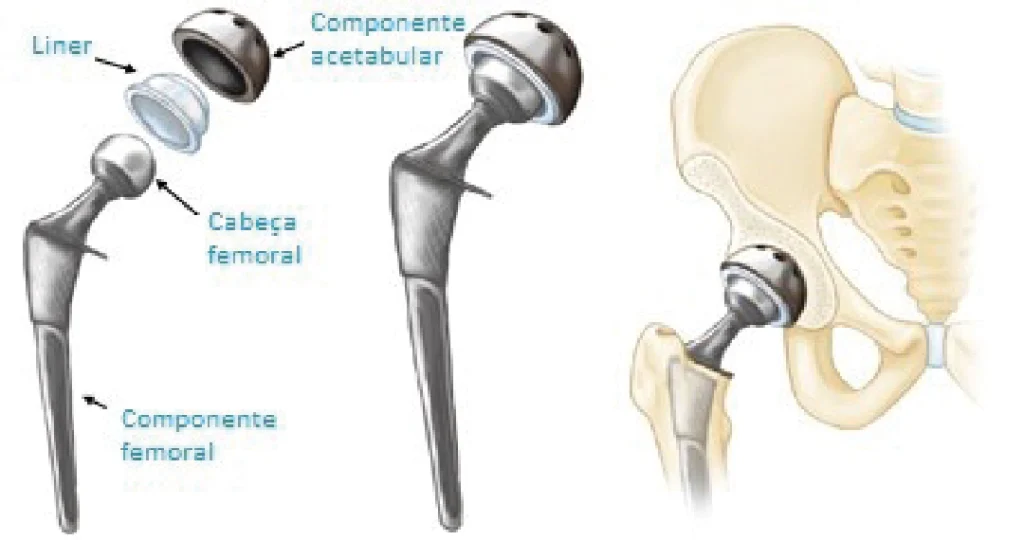 Artroplastia Total do Quadril (ATQ) em Goiânia | Dr. Fernando Ferro | Cirurgia do Quadril em Goiânia