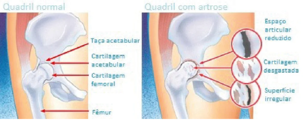 Artrose | Dr. Fernando Ferro | Cirurgia do Quadril em Goiânia