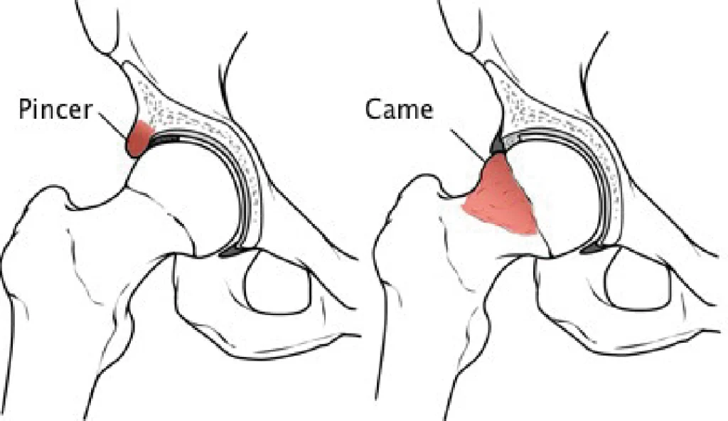 Impacto Femoroacetabular | Dr. Fernando Ferro | Cirurgia do Quadril em Goiânia