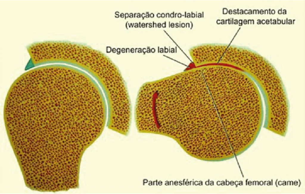 Impacto Femoroacetabular | Dr. Fernando Ferro | Cirurgia do Quadril em Goiânia