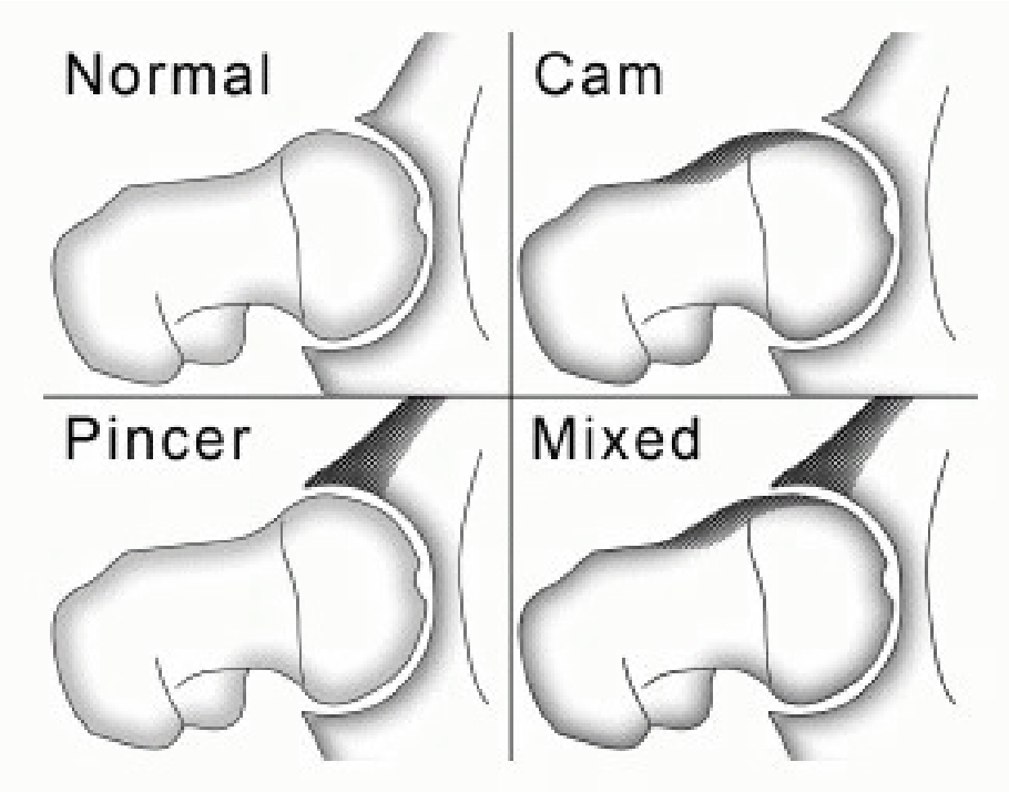 Impacto Femoroacetabular | Dr. Fernando Ferro | Cirurgia do Quadril em Goiânia